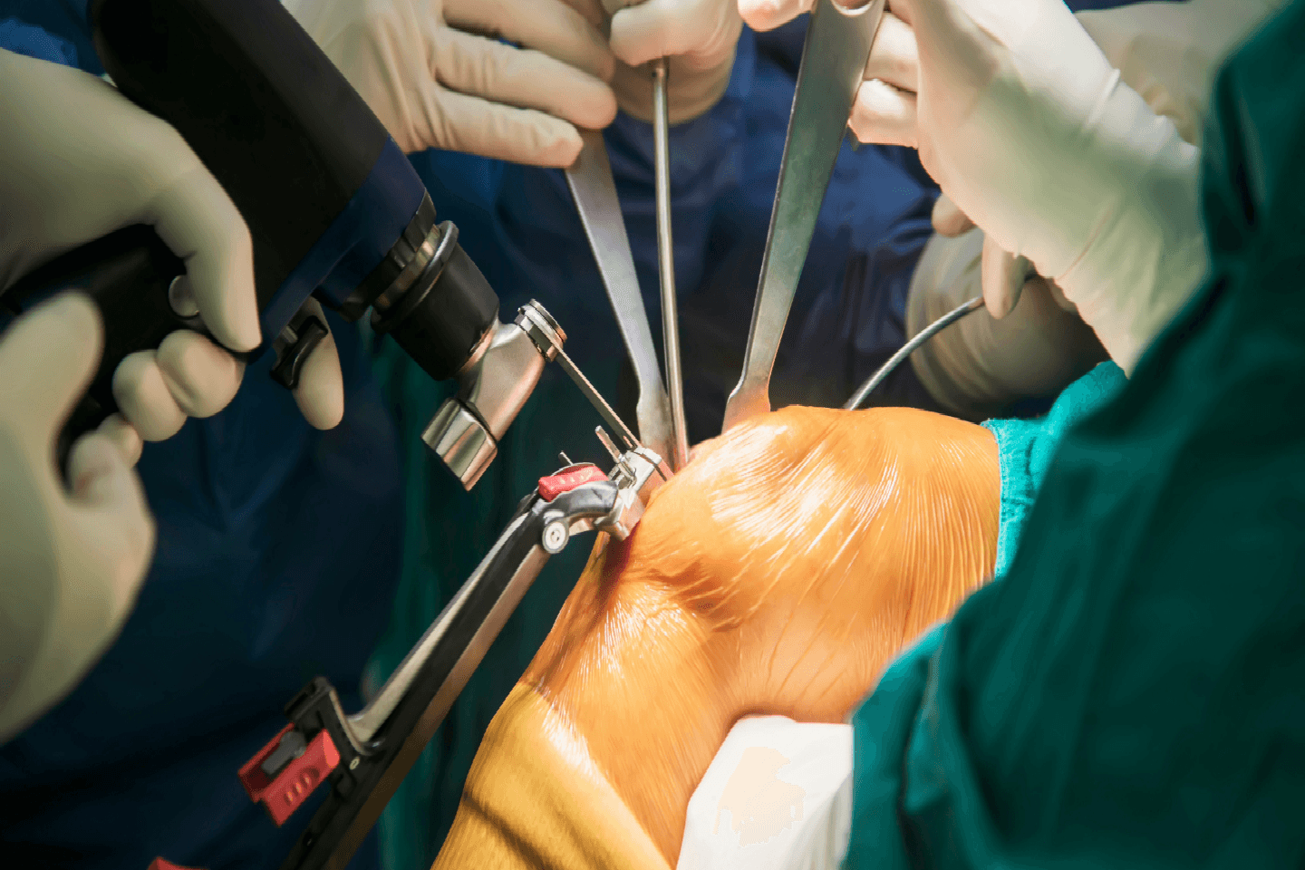 Minimally Invasive Orthopedic
